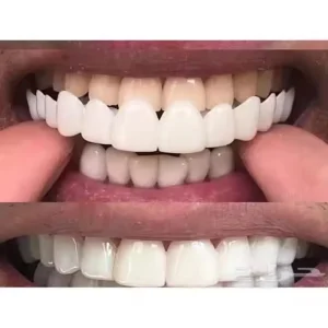 Alternative view of Snap-On Smile